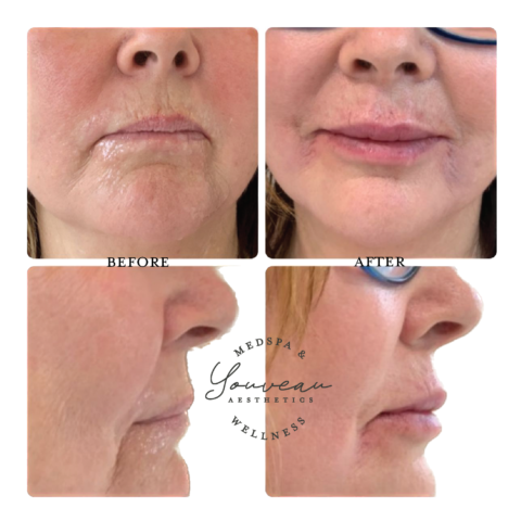 LIP FILLER