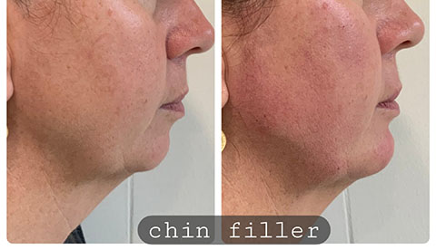 FILLER